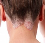 Seboreik Dermatit nedir